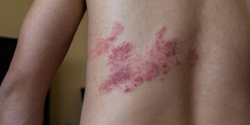 ‘La espina invisible’, la campaña que sensibiliza sobre el herpes zóster a través de una rosa simbólica