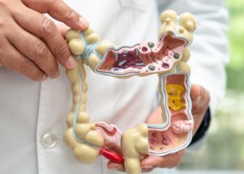 El 50% de los casos de cáncer de colon podrían prevenirse
