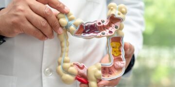El 50% de los casos de cáncer de colon podrían prevenirse