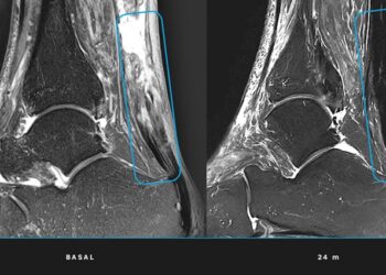 Un equipo multidisciplinar logra regenerar el tendón de Aquiles sin cirugía mediante células madre mesenquimales cultivadas