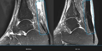 Un equipo multidisciplinar logra regenerar el tendón de Aquiles sin cirugía mediante células madre mesenquimales cultivadas
