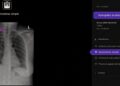 Telefónica y Harrison.ai se alían para apoyar el diagnóstico en radiografías de tórax con IA