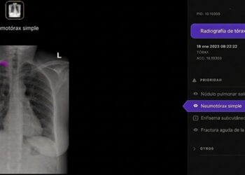 Telefónica y Harrison.ai se alían para apoyar el diagnóstico en radiografías de tórax con IA