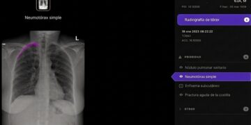 Telefónica y Harrison.ai se alían para apoyar el diagnóstico en radiografías de tórax con IA