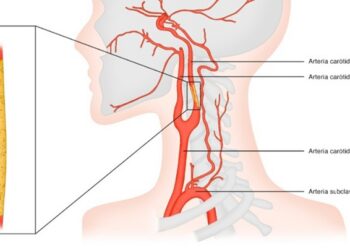 Una estenosis en las arterias carótidas puede avanzar sin síntomas hasta provocar un ictus