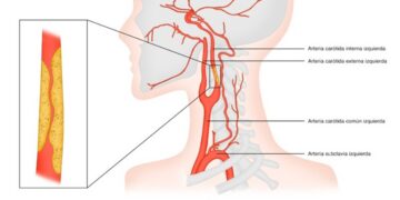 Una estenosis en las arterias carótidas puede avanzar sin síntomas hasta provocar un ictus