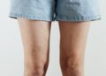 Piernas hinchadas y varices: señales que no debemos normalizar
