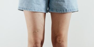 Piernas hinchadas y varices: señales que no debemos normalizar