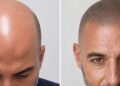 Micropigmentación para acabar con la calvicie