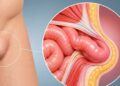 Operarse de una hernia y volver a casa el mismo día: cuándo es posible la cirugía ambulatoria