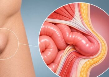 Operarse de una hernia y volver a casa el mismo día: cuándo es posible la cirugía ambulatoria